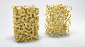 Osteoporosis: ¿se puede prevenir?