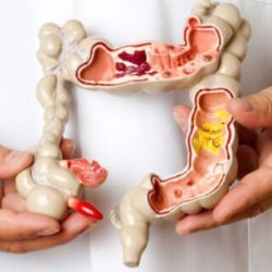 GrupoFarma-Ecuador-Blog-Colon-Intestino-Irritable-320x320